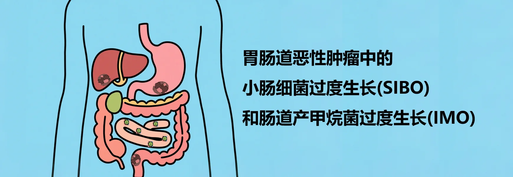 前沿论文 | 胃肠道恶性肿瘤中的小肠细菌过度生长(SIBO)和肠道产甲烷菌过度生长(IMO)封面